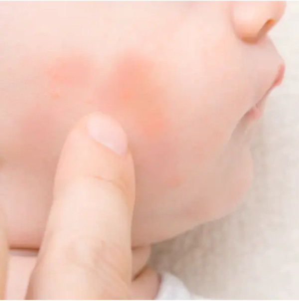 Dermatitis atopica